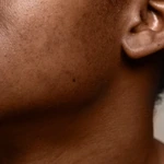 Hyperpigmentation logo